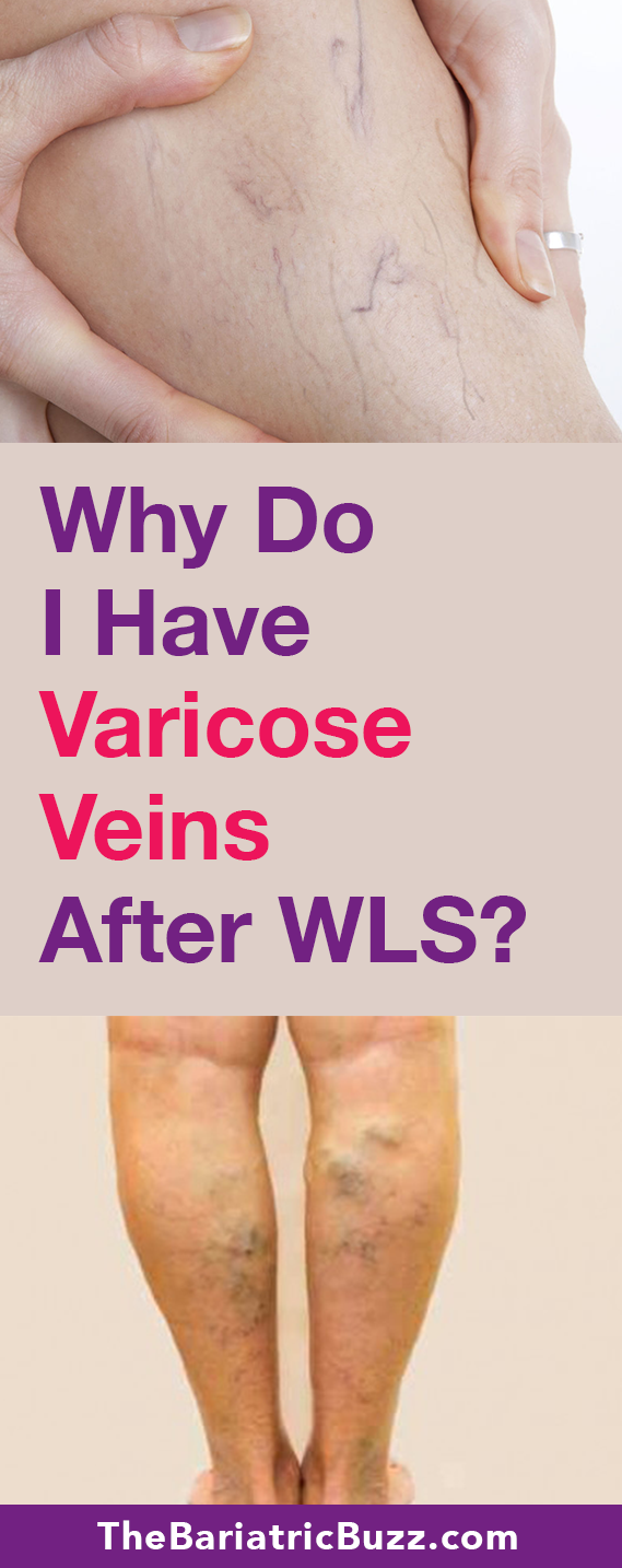 Varicose Veins After WLS
