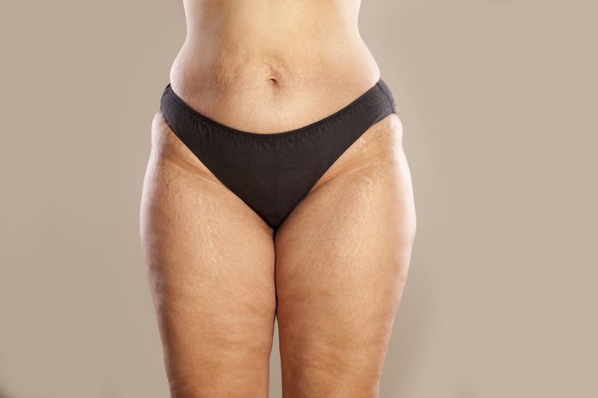 Your Body After Bariatric Surgery